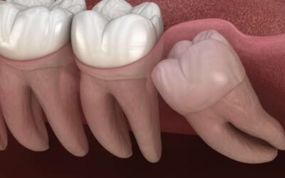 Wisdom Tooth Removal: When and Why You Might Need It